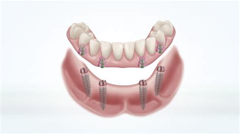 Implant Supported Vs Implant Retained Dentures - tacitceiyrs