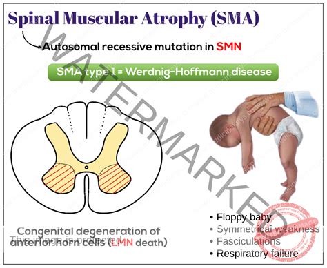 Spinal muscular atrophy (SMA) - Medicine Keys for MRCPs