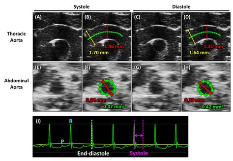 Measurements of aortic images. Images of the thoracic aorta captured ...