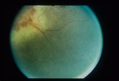 Paracentral Scotoma (Case 3) - Retina Image Bank