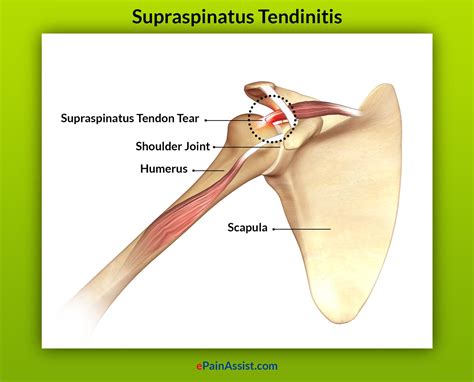 Supraspinatus Tendinitis Cause Sign Symptoms Physiotherapy Treatment | The Best Porn Website