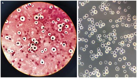 Cryptococcus neoformans- An Overview