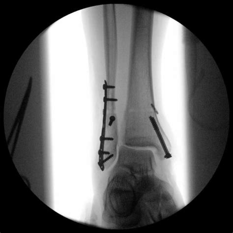 Broken Ankle after surgery - democratiz3D® Processing - embodi3D.com