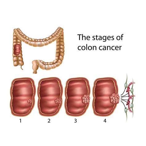 Stages of Colon Cancer - Colon Cancer Treatment in India | Cytecare