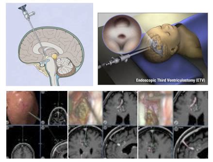 Hydrocephalus — Dr Raoul E Pope - Neurosurgeon & Spine Surgeon, Sydney ...