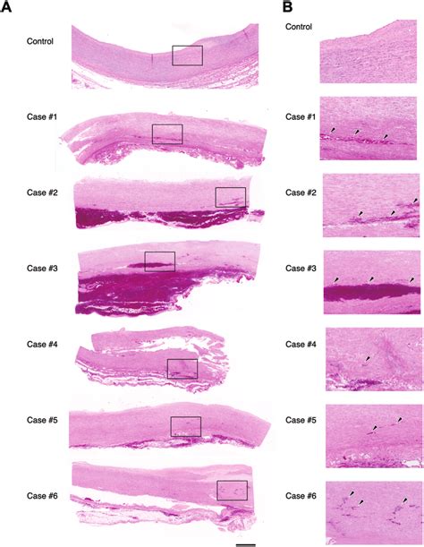 Aortic Dissection Histology