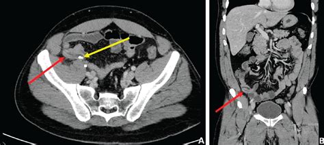 Why Ct Scan Abdomen Pelvis