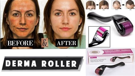 how to use derma roller || Hair Growth Wrinkles Review ||Before After ...