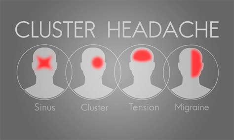 Cluster Headache: Causes, Symptoms & Treatment