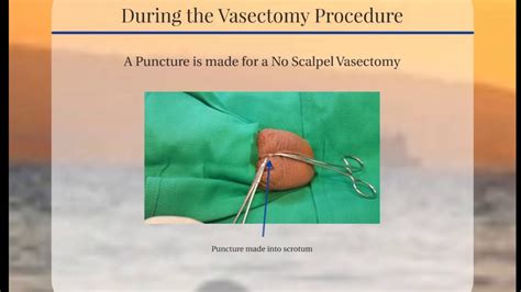 Vasectomy 1 - YouTube