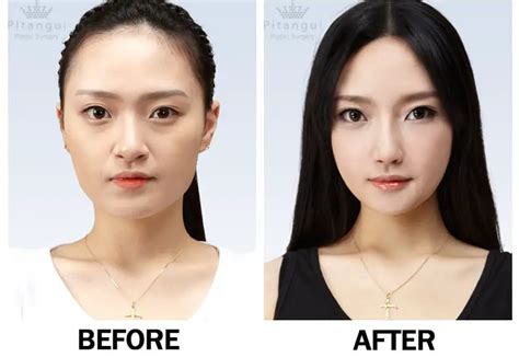 Plastic Surgery Dimple Korea Before After Best - famousfaceshub