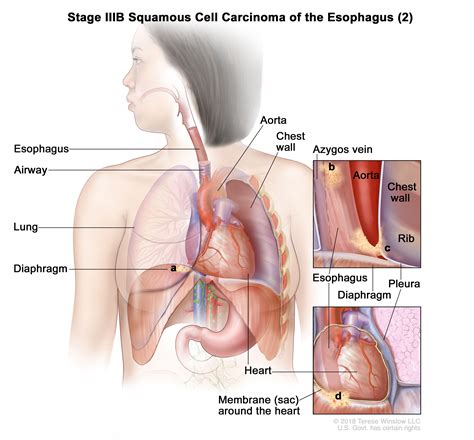 Esophageal Cancer | Vanderbilt-Ingram Cancer Center