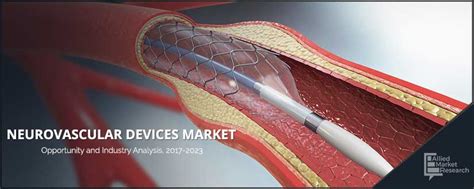 Neurovascular Devices Market Size, Share | Industry Growth, 2023