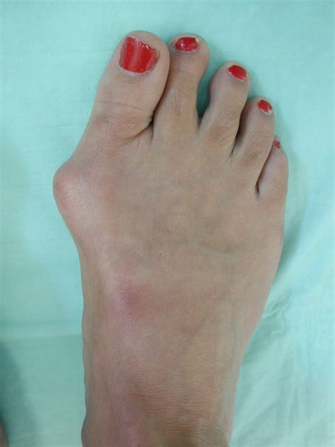 Juanetes (Bunions)