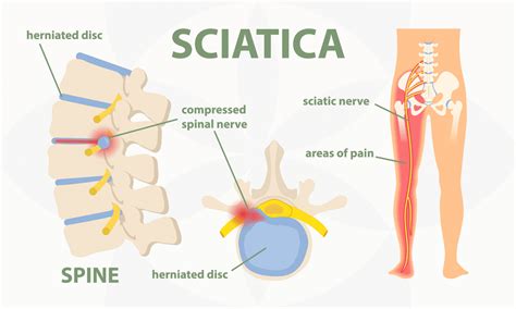 Sciatica treatment Jersey CI → Human Health Chiropractic