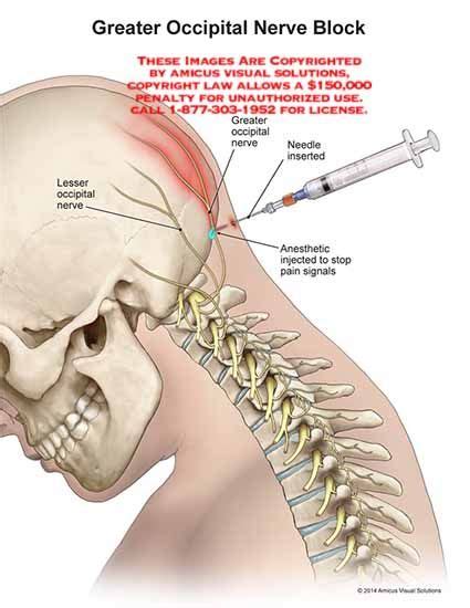 Trigger Point Injections Headache - Headache