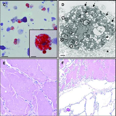 (PDF) Hereditary Pulmonary Alveolar Proteinosis Pathogenesis ...