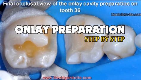 ONLAY PREPARATION: On tooth 36 with distal margin coronal relocation - Step by Step