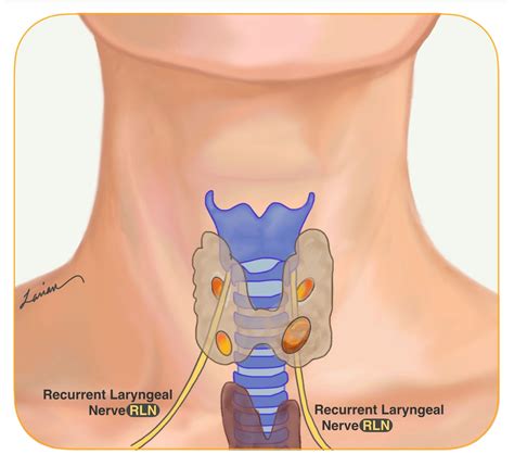 recurrent laryngeal nerve RLN - Hyperparathyroidism Surgery - Dr. Babak ...