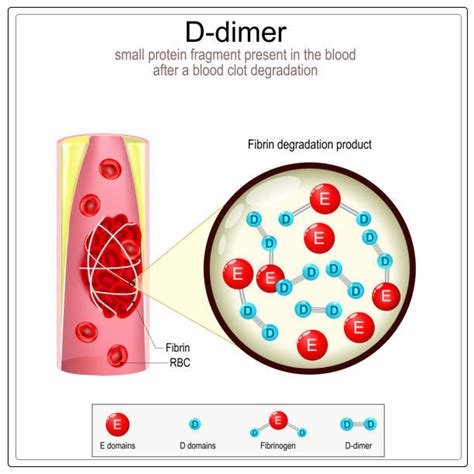 D Dimer Test: Definition, Diagnosis, and What to Expect - Egiomed