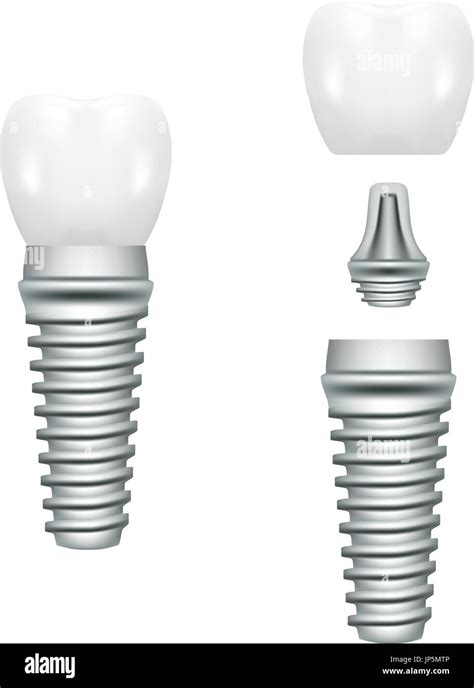 Realistic Dental Implant Structure With All Parts Crown, Abutment, Screw Isolated On A White ...