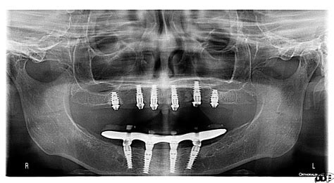 Dental Implant Xray