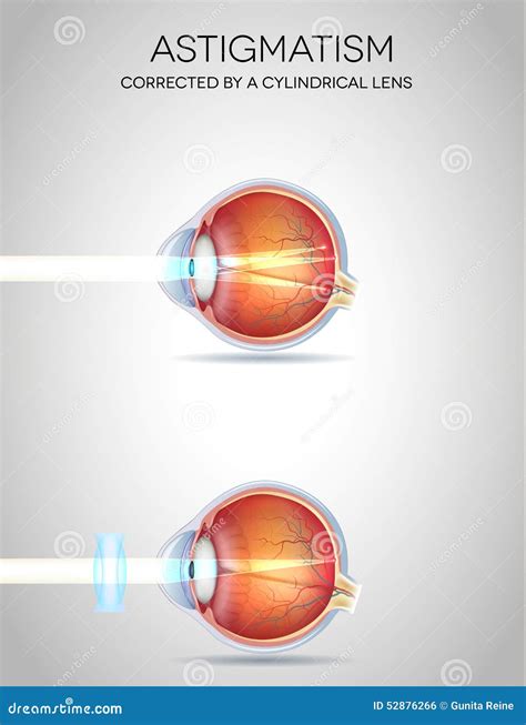 Eye vision disorders stock vector. Illustration of medicine - 52876266