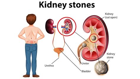 What Causes Kidney Stones? – NutritionFact.in