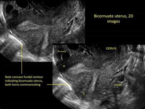 Congenital uterine anomalies: A resource of diagnostic images, Part 2 ...