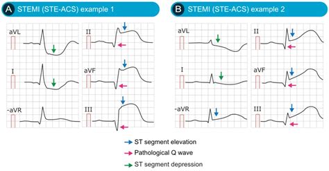 Classification of Acute Coronary Syndromes (ACS) & Acute Myocardial Infarction (AMI ...