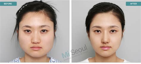 Plastic Surgery Before And After Nose Korean