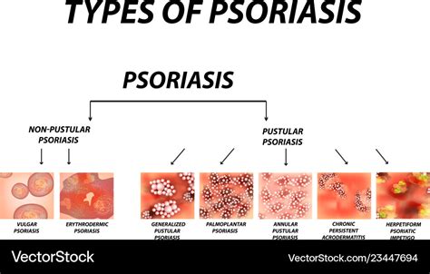 Types of psoriasis pustular and not pustular Vector Image