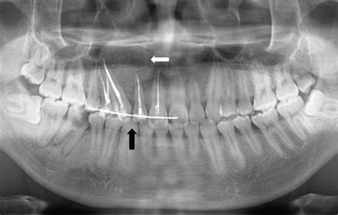 A 24-year-old male presenting with odontogenic keratocyst in the right... | Download Scientific ...