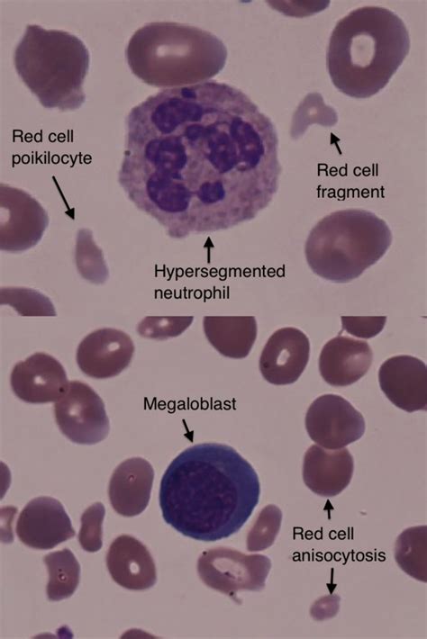 A student with macrocytic anaemia | The BMJ