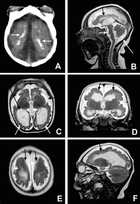 Clinical features and neuroimaging (CT and MRI) findings in presumed Zika virus related ...