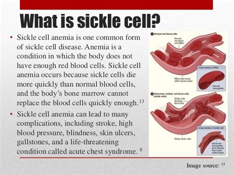 Sickle cell anemia