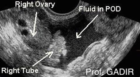 Pouch Of Douglas Fluid Ultrasound / Pelvic Free Fluid | Lesson #106 - Because fluid from the ...