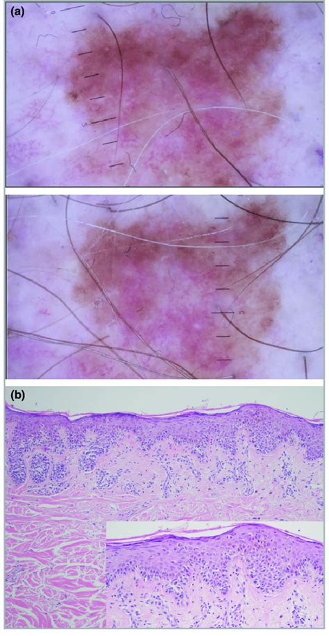 (a) Sequential digital dermoscopy imaging of a melanocytic lesion... | Download Scientific Diagram