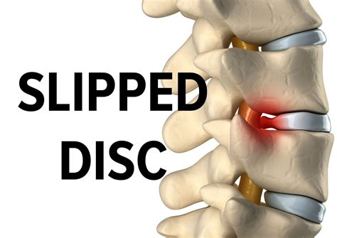 Slipped (Herniated) Disc: Symptoms and Treatments – RetraceHealth.com