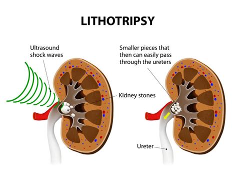 Breaking 3 mm to 8 mm Stones in Ureter: Specialists in Manhattan and Brooklyn - NYC Kidney Stone ...