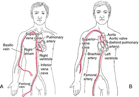 Definition of Left-sided cardiac catheterization in the Medical Dictionary by The Free ...