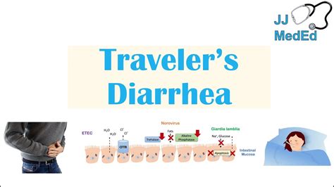 Video Thumbnail: Traveler’s Diarrhea | Causes (Bacteria, Viruses, etc ...