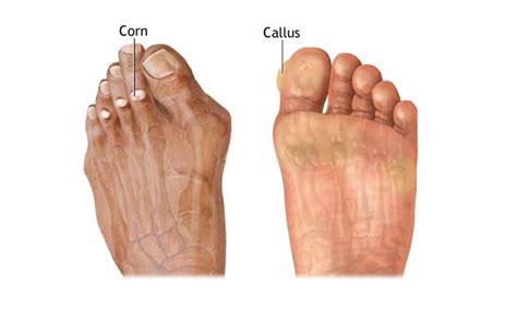 Corn and Callus - Causes Presentation and Treatment | Bone and Spine