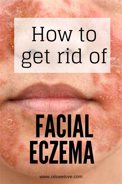 Pin on The Treatment Of Eczema