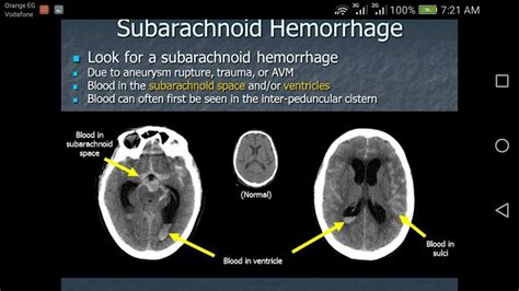 SubarChnoid hge