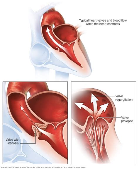 Enfermedad de las válvulas cardíacas - Síntomas y causas - Mayo Clinic