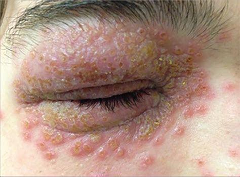 Eruption of Eyelid Target Lesions | Adolescent Medicine | JAMA Ophthalmology | JAMA Network