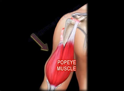 Proximal Biceps Tendon Rupture — OrthopaedicPrinciples.com