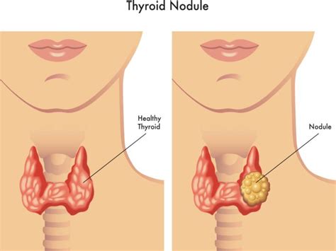 What Causes Thyroid Nodules To Grow?