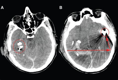 Gunshot Wounds: A Targeted Approach